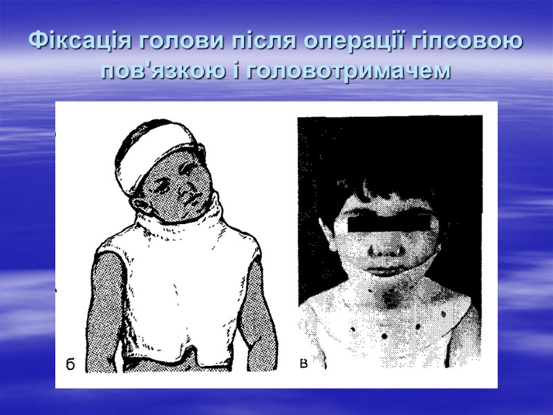 Фіксація голови після операції гіпсовою пов'язкою і головотримачем